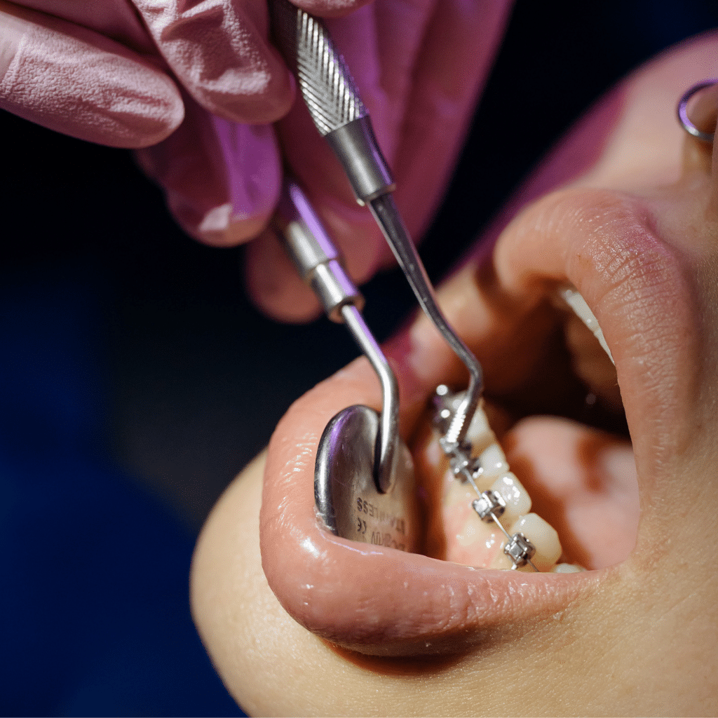 Bagues métalliques ou céramiques pour corriger l’alignement dentaire