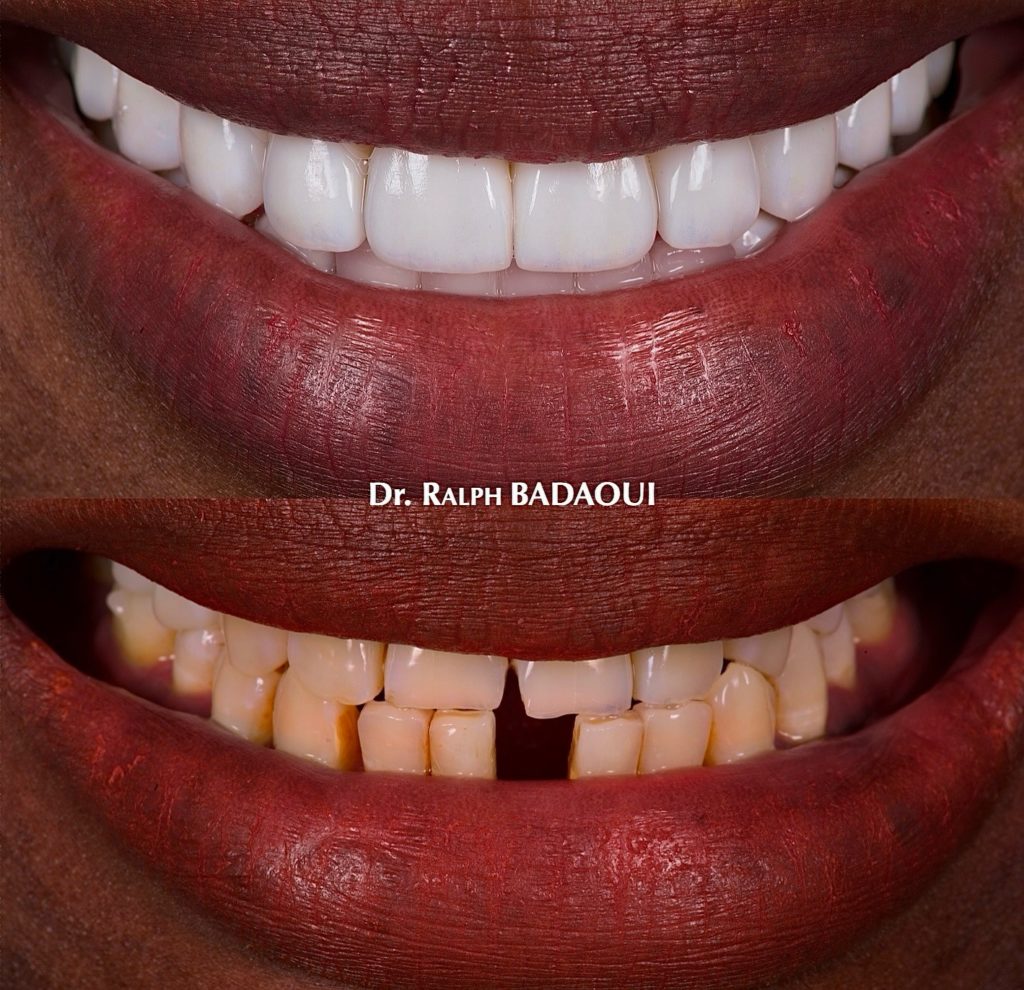 Cas clinique orthodontique : résultat d’alignement dentaire 1