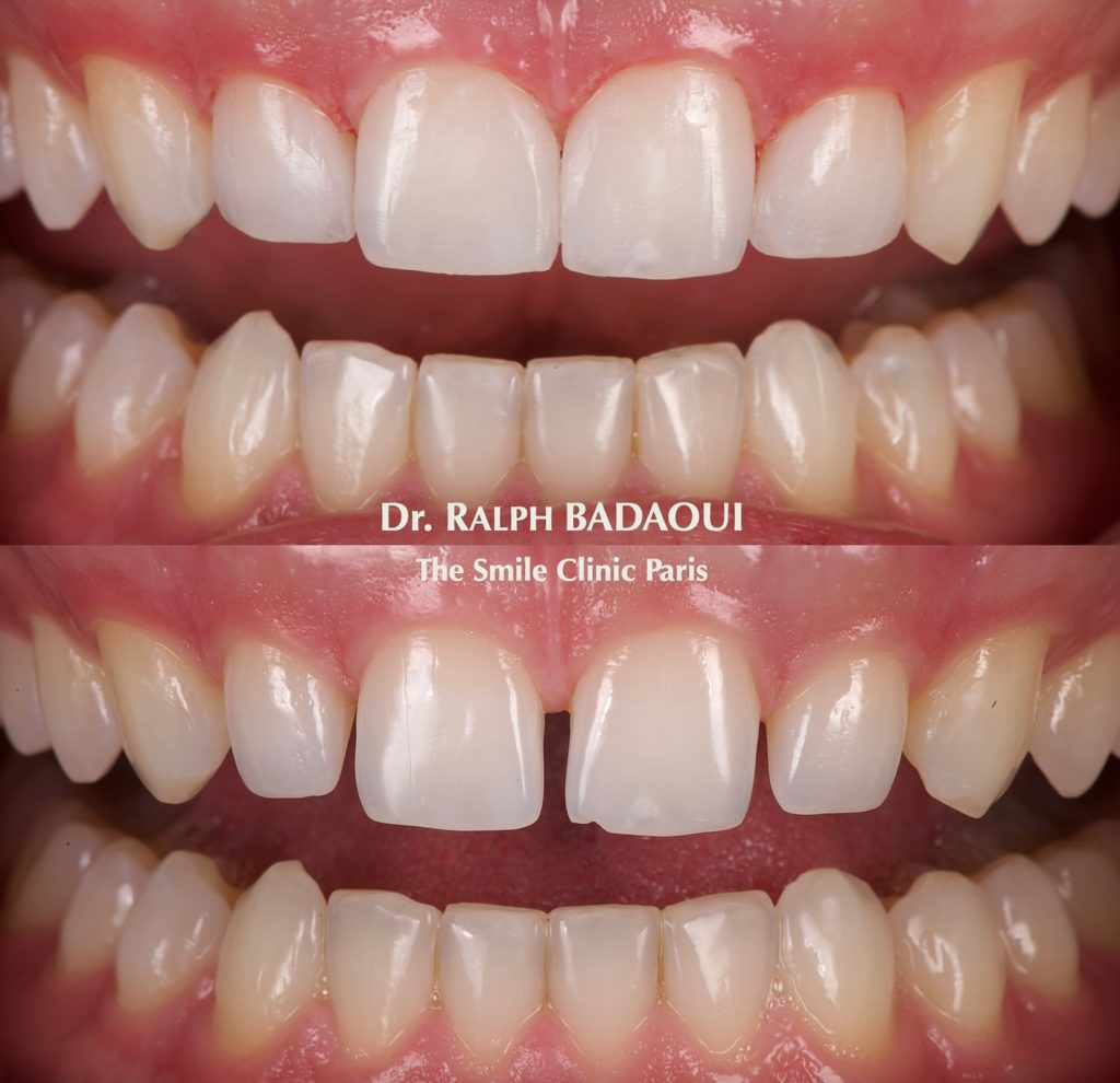 Cas clinique orthodontique : résultat d’alignement dentaire 2