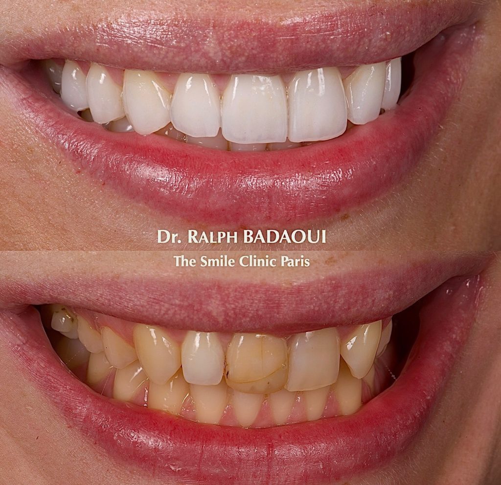 Cas clinique orthodontique : résultat d’alignement dentaire 3