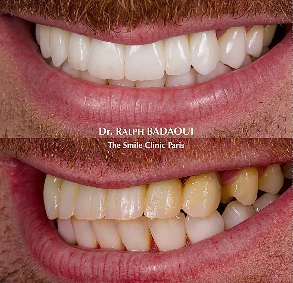 Cas clinique orthodontique : résultat d’alignement dentaire 4