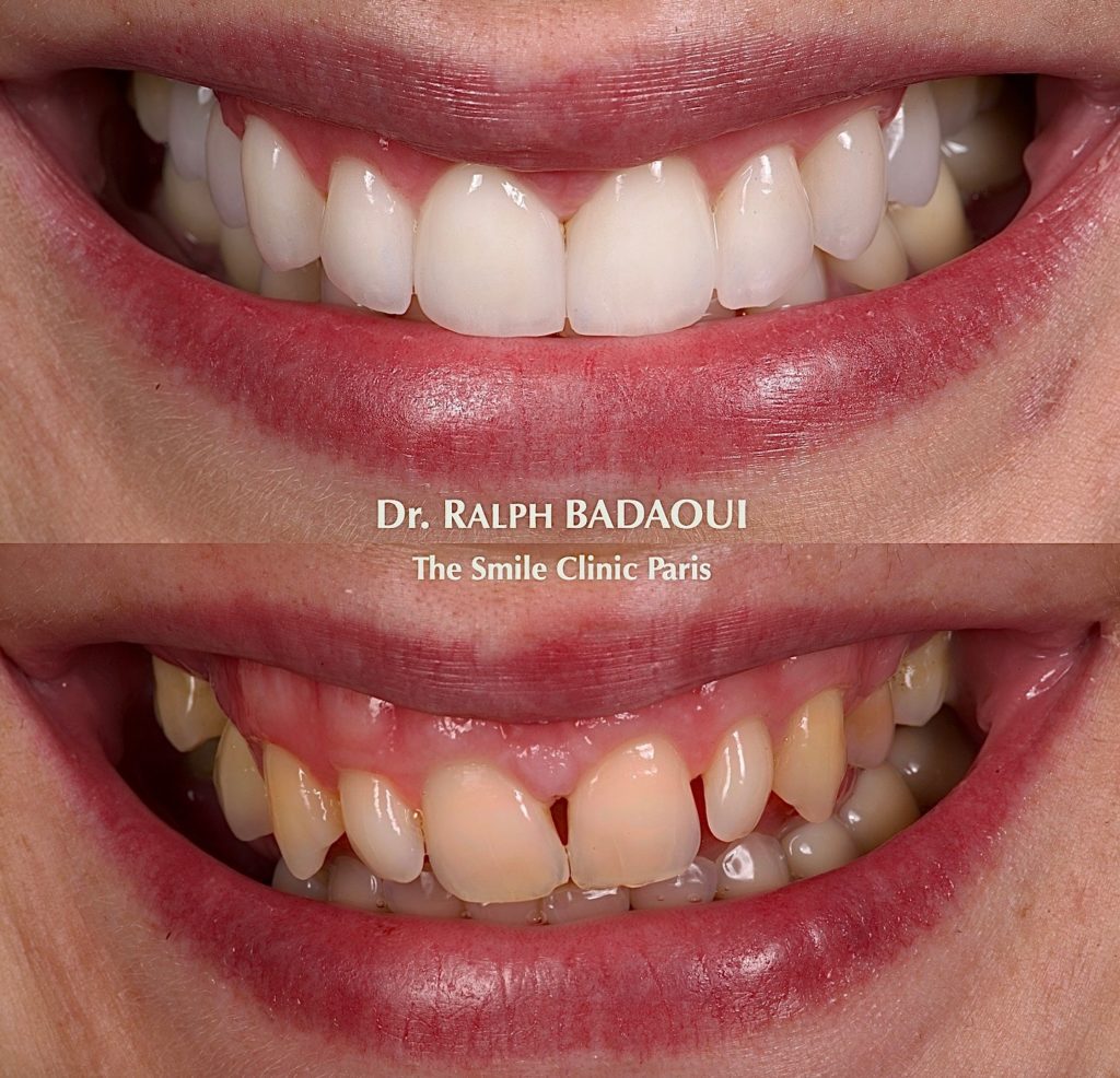 Cas clinique orthodontique : résultat d’alignement dentaire 5