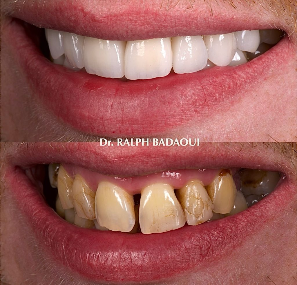 Cas clinique orthodontique : résultat d’alignement dentaire 6
