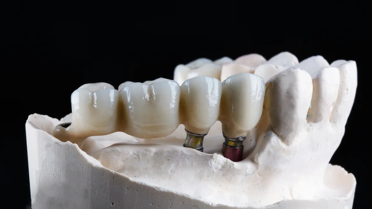 Implants dentaires et couronnes pour recouvrir les dents