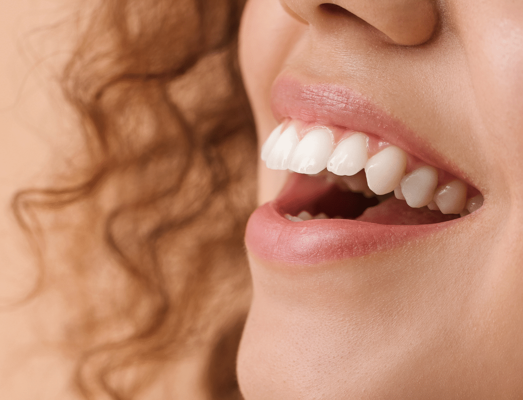 Orthodontie linguale avec attaches placées sur la face interne des dents