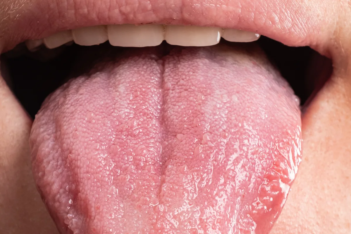 L’orthodontie linguale