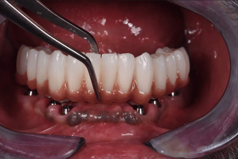 Restauration complète du sourire par implants dentaires