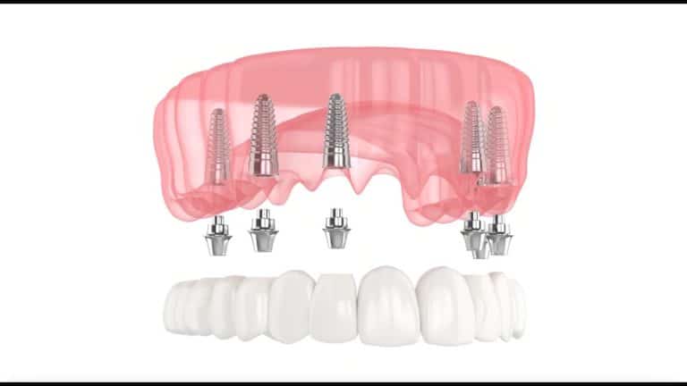 Implants dentaires pour une restauration All-on