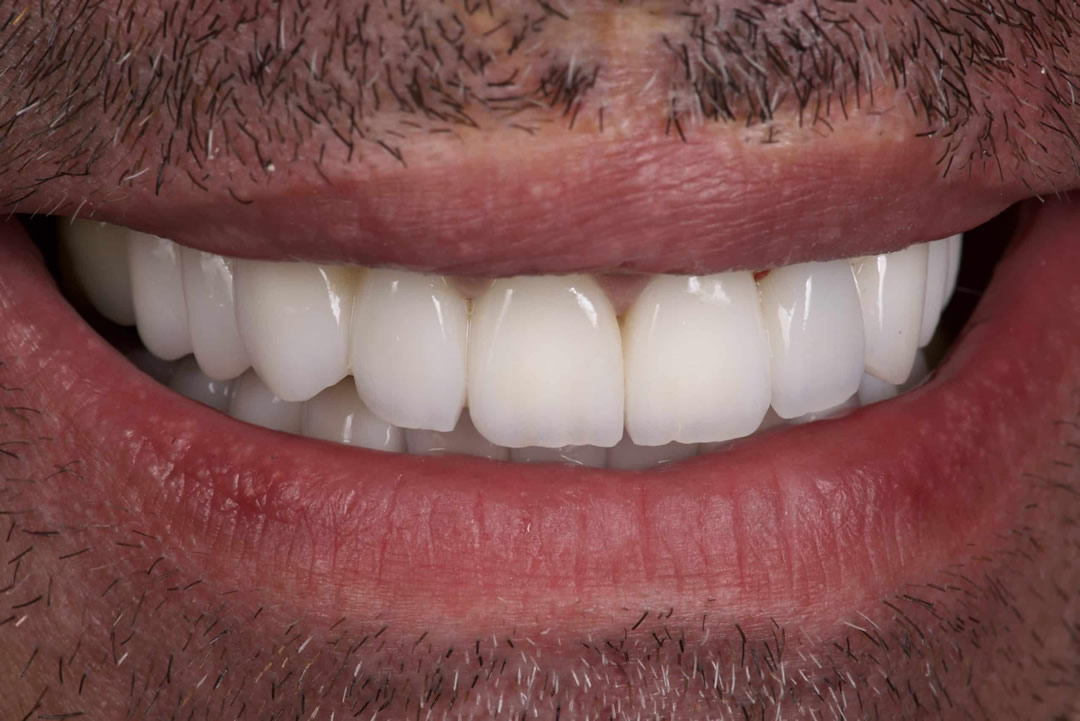 Après — transformation esthétique, cas 2