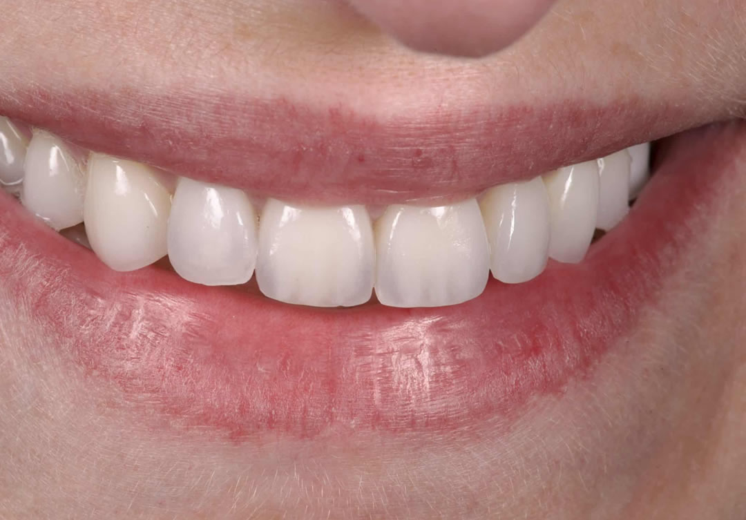 Après — transformation esthétique, cas 3