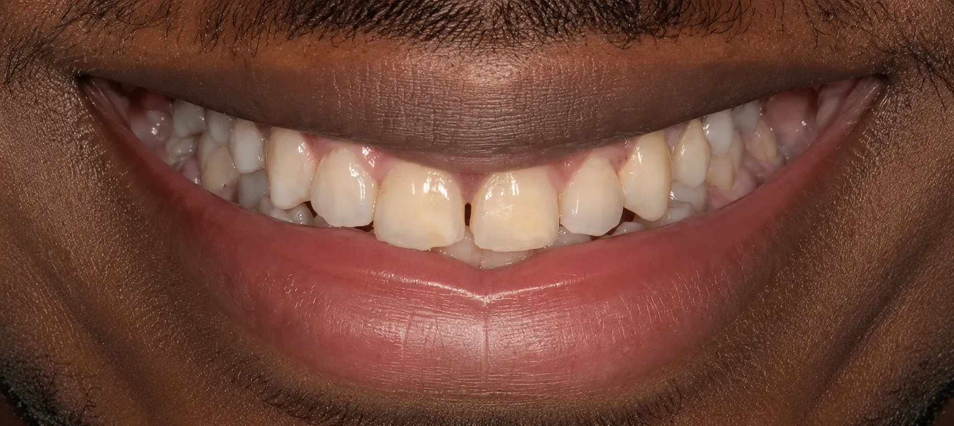Avant blanchiment dentaire cas 2