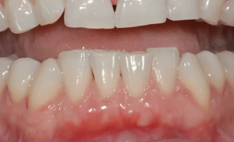 Récession gingivale après traitement cas 1