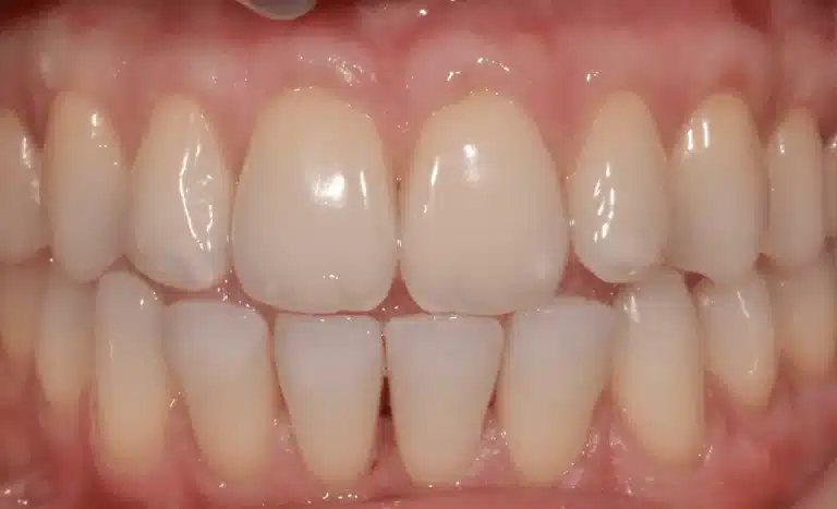 Récession gingivale après traitement cas 2