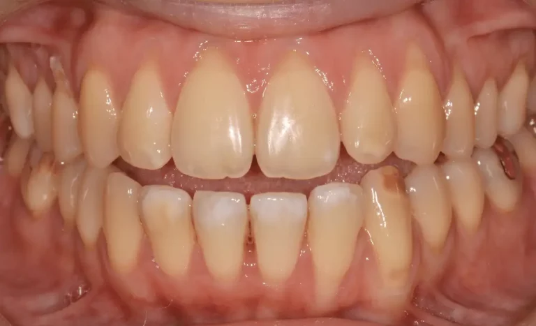 Récession gingivale avant traitement cas 2