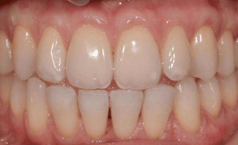 Récession gingivale après traitement cas 3