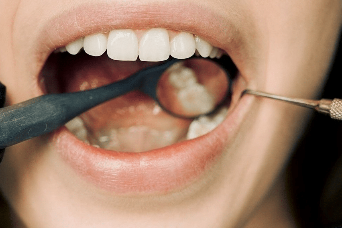 Douleurs gingivales persistantes