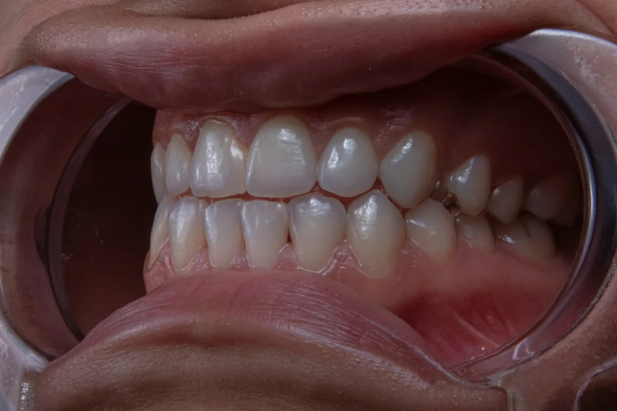 Récession gingivale et déchaussement dentaire