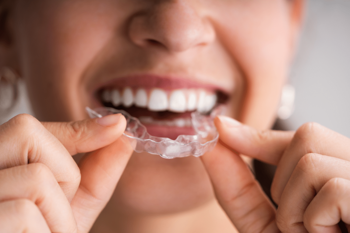 Corriger des dents grises ou transparentes