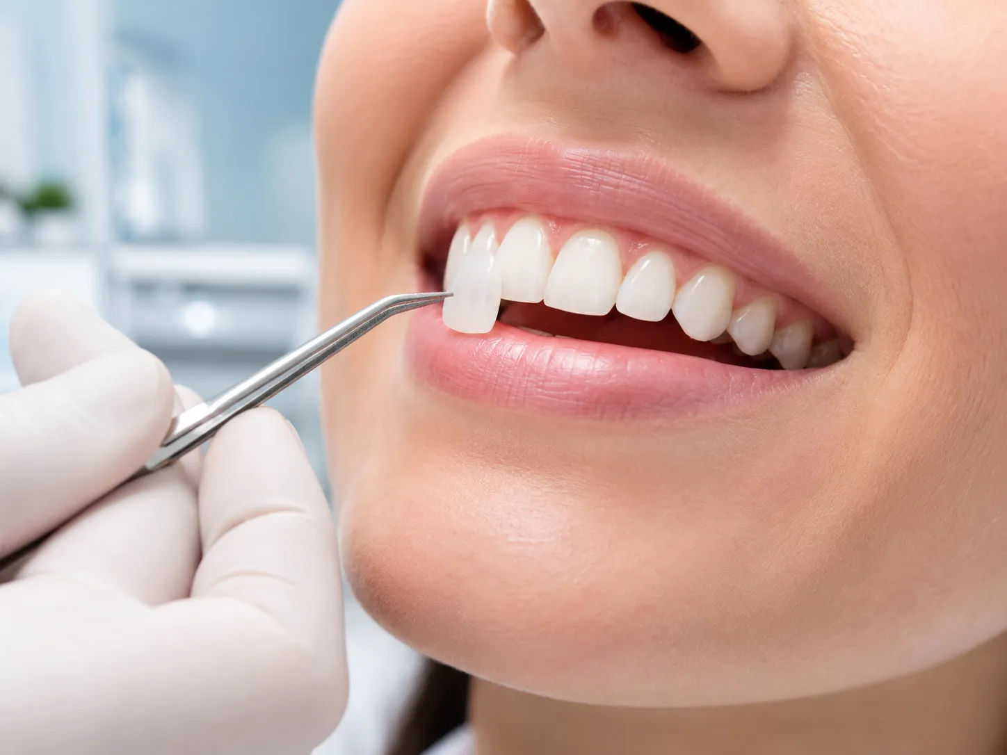 Facettes dentaires pour un sourire impeccable