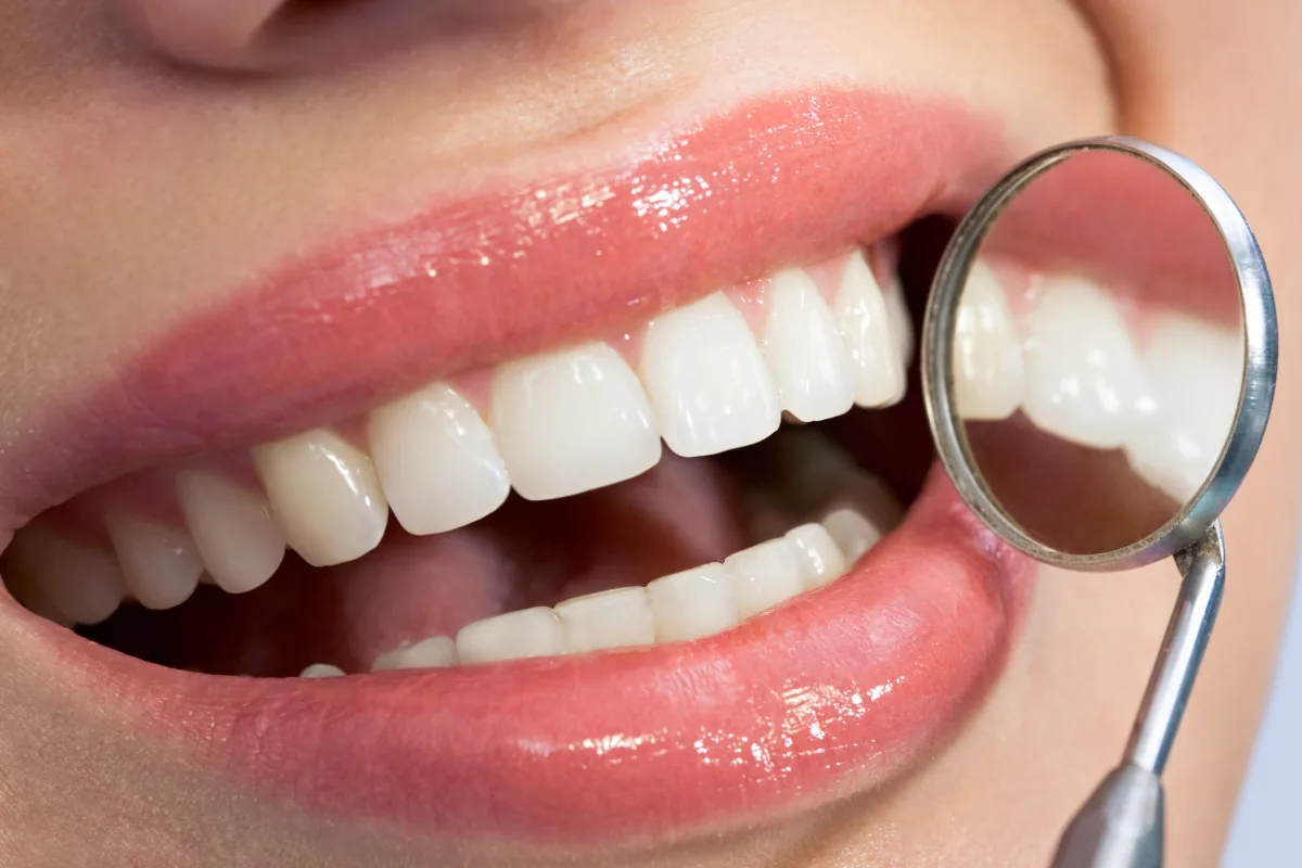Sourire avec facettes dentaires composites