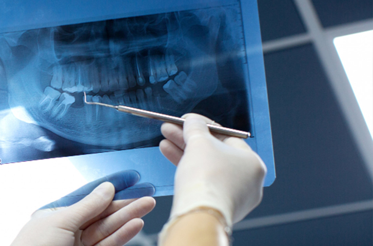 Endodontie au Cabinet Dentaire de la Madeleine