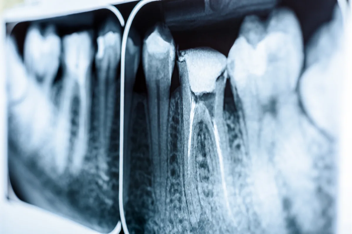 Endodontie au Cabinet Dentaire de la Madeleine