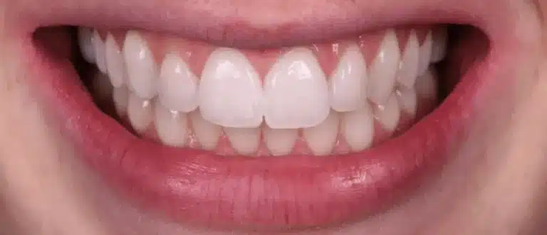 Taches blanches sur les dents après traitement cas 1