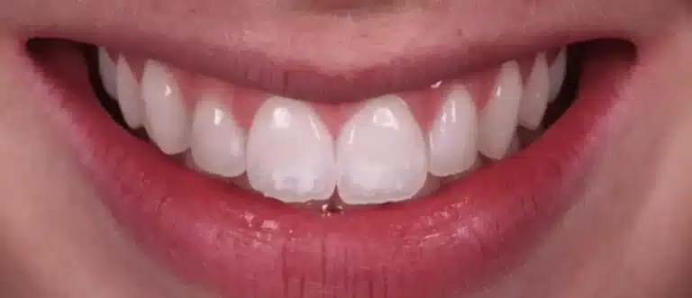 Taches blanches sur les dents avant traitement cas 1