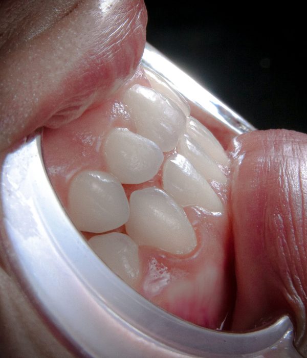 Encombrement dentaire et dents qui se chevauchent