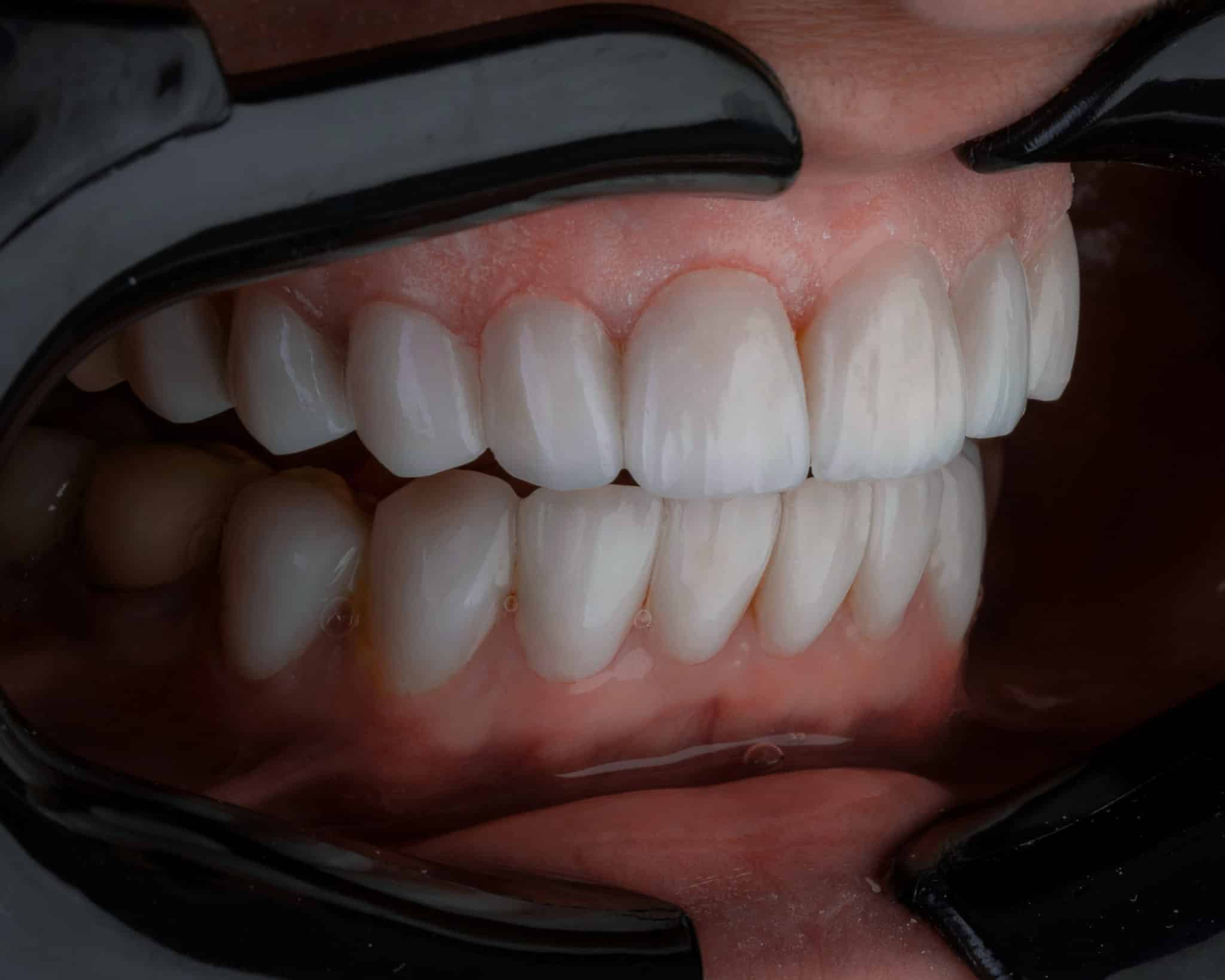 Mastication et occlusion dentaire