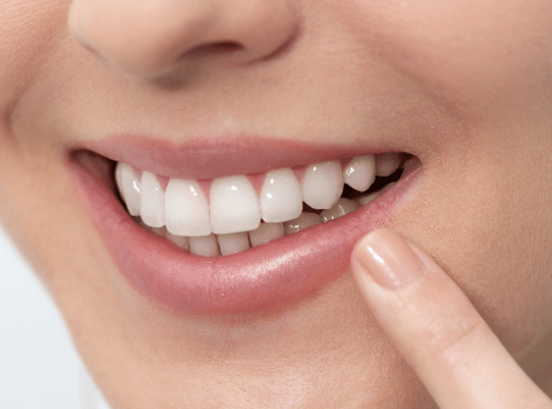 Conseils après extraction des dents de sagesse