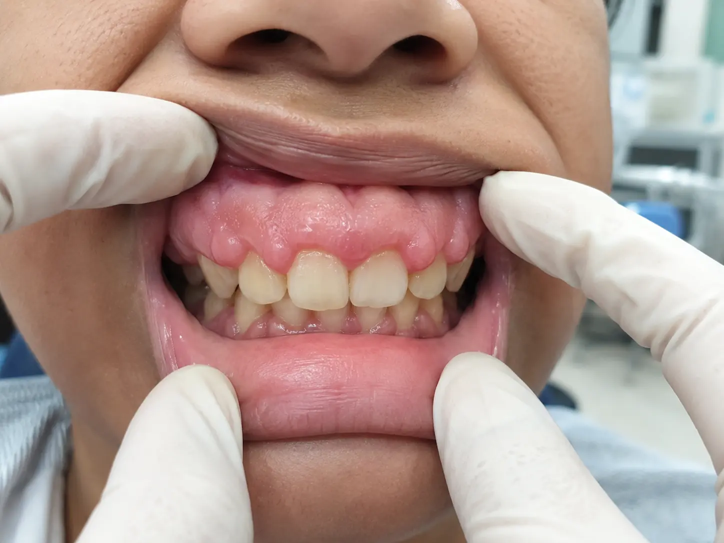 Hyperplasie gingivale avant gingivectomie