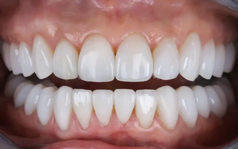 Traitement de gingivectomie à Paris