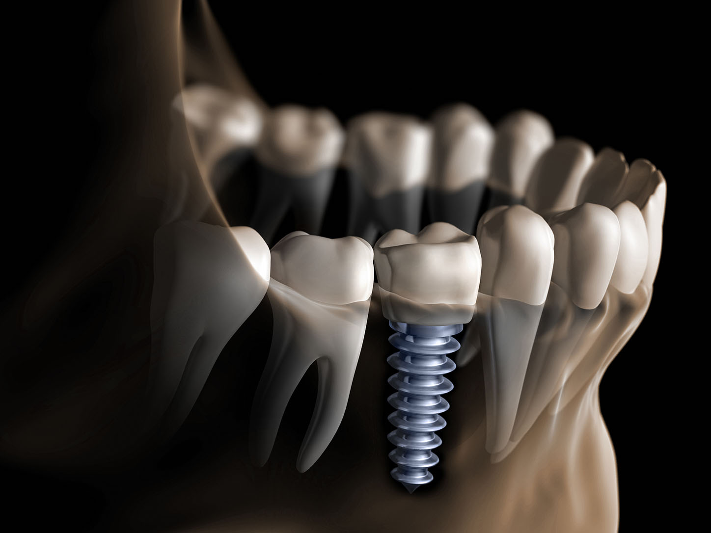 Implant dentaire à Paris
