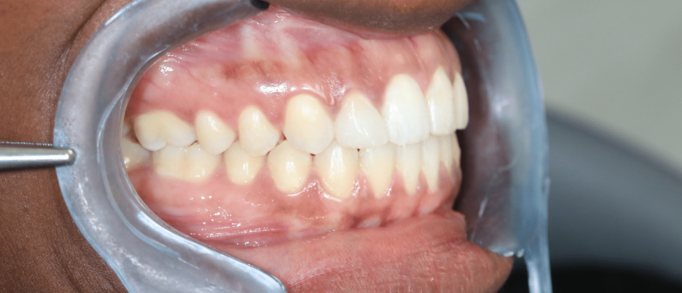 Après traitement Invisalign — cas 1