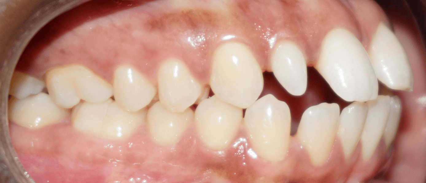 Avant traitement Invisalign — cas 1