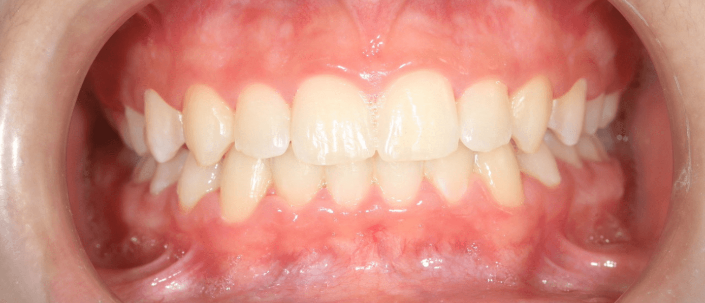 Après traitement Invisalign — cas 2