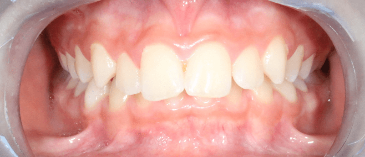Avant traitement Invisalign — cas 2
