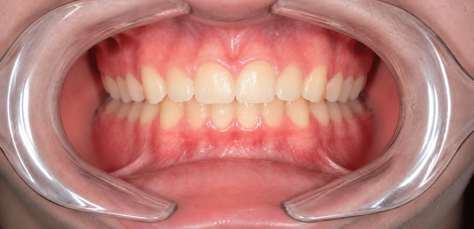 Orthodontie après