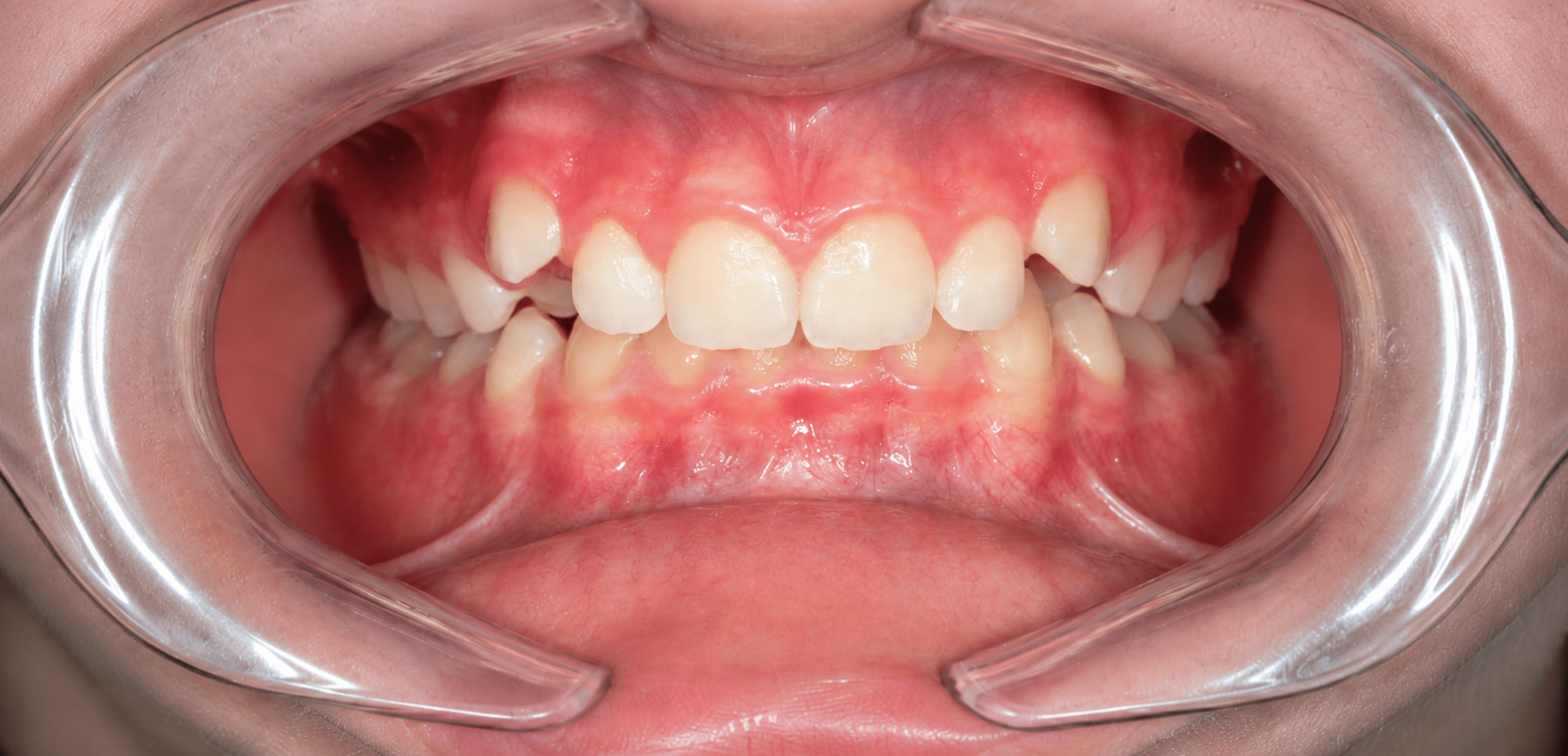 Orthodontie avant