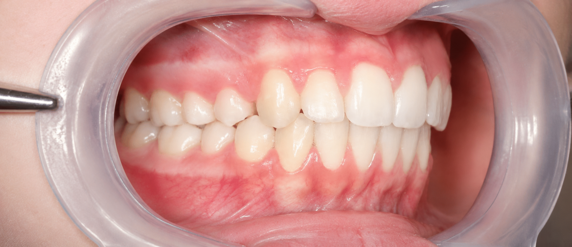 Après traitement orthodontique — cas 2