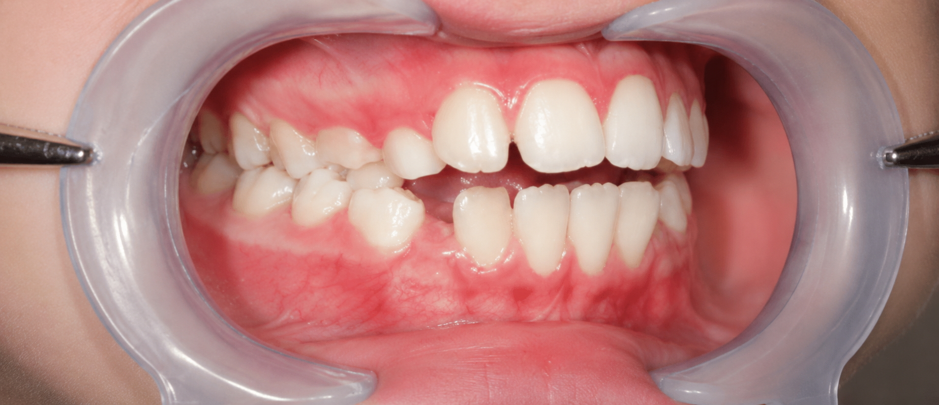 Avant traitement orthodontique — cas 2
