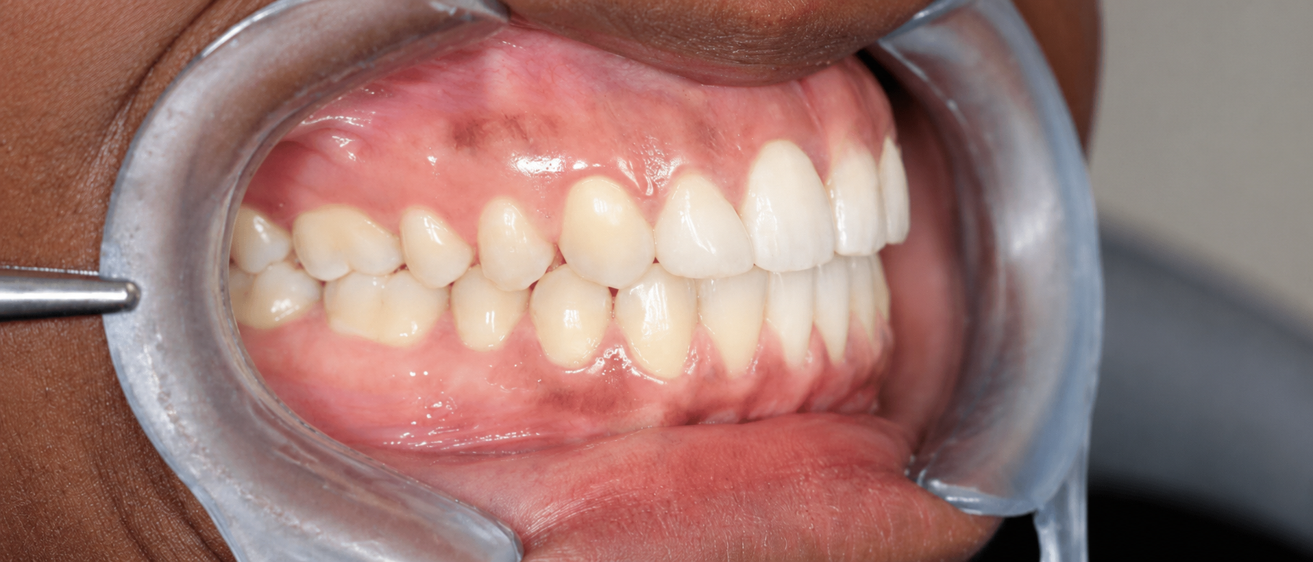 Après traitement orthodontique — cas 3