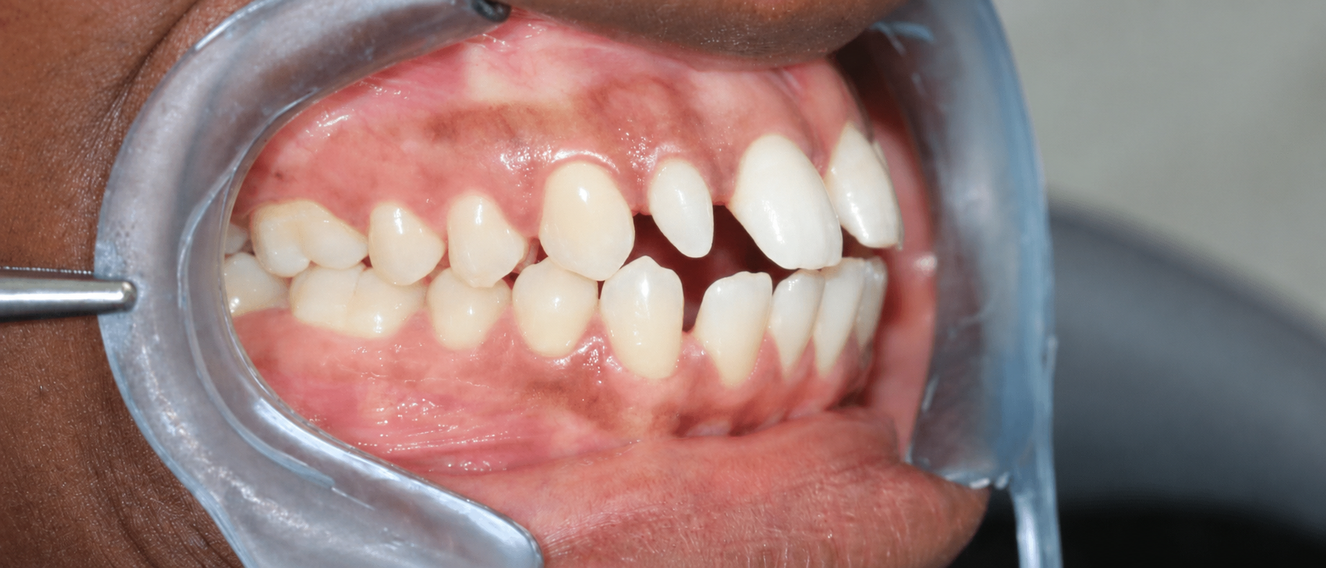 Avant traitement orthodontique — cas 3