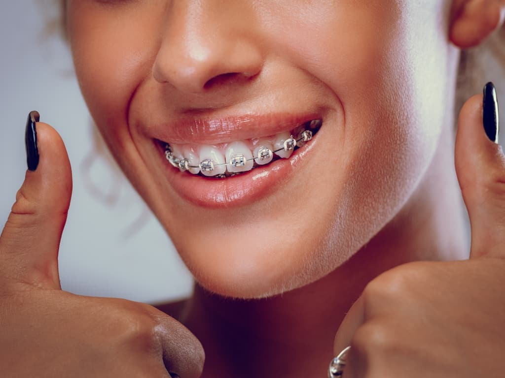 Traitement orthodontique fixe avec bagues dentaires