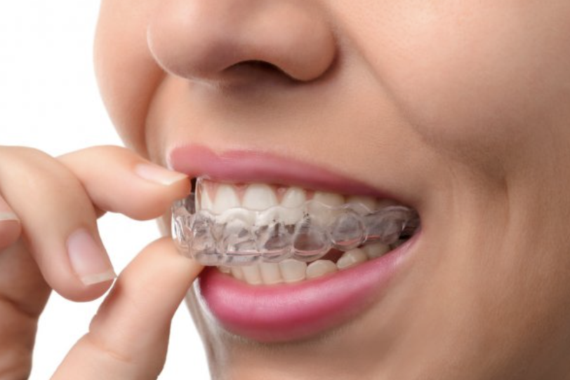 Gouttière orthodontique transparente amovible