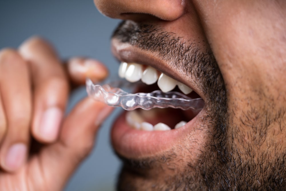 Aligneur transparent Invisalign