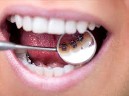 Orthodontie linguale placée à l’intérieur des dents