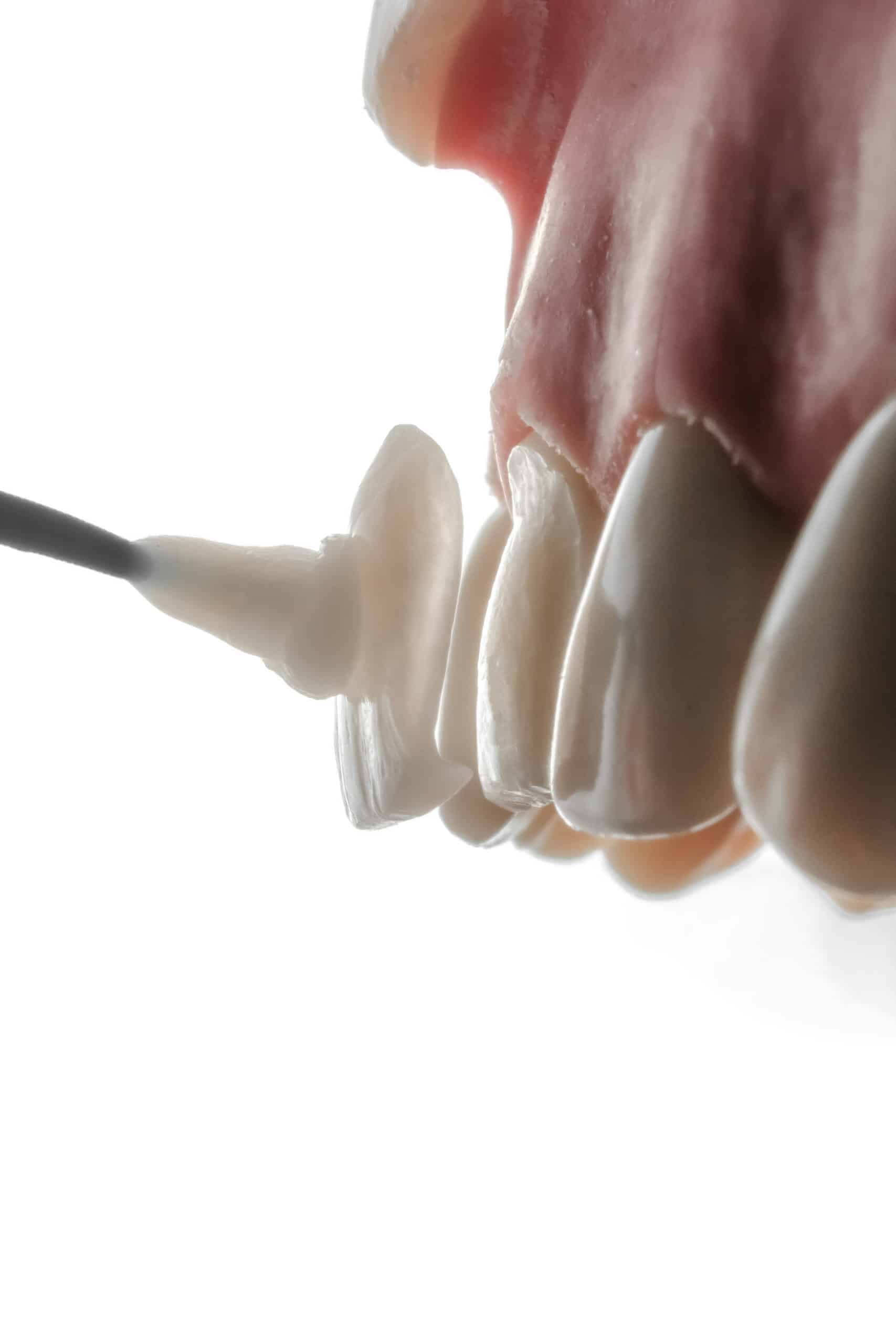 Traumatismes mécaniques des gencives