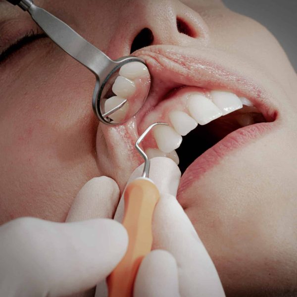 Récession gingivale au Cabinet Dentaire de la Madeleine